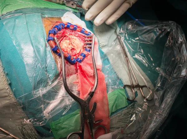 Craniotomy in chronic subarachnoid hemorrhage — Stock Photo, Image