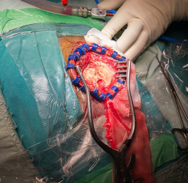 Craniotomy in chronic subarachnoid hemorrhage