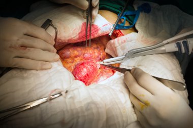 Distal abdominal aort anevrizma tespit