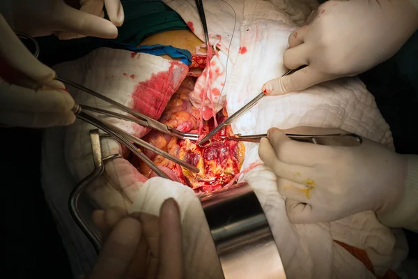 Jahitan dekat arteri lumbar dalam aneurisma aorta perut — Stok Foto