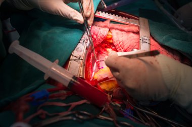 Coronary artery bypass grafting clipart
