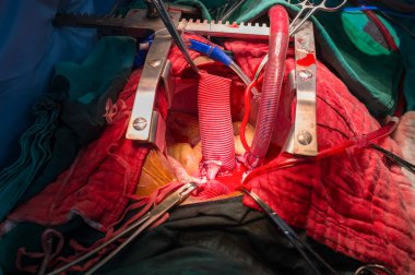 aort anevrizması artan implantasyon yeniden koroner