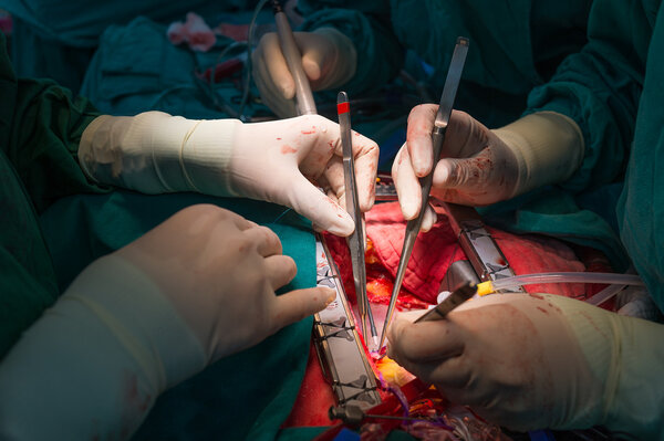 Coronary artery bypass grafting