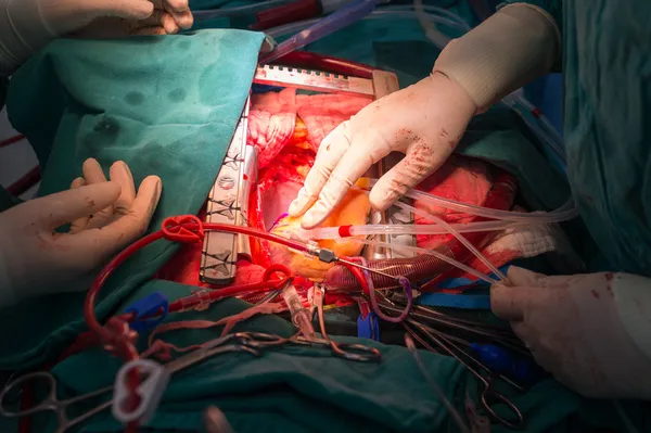 Koronararterien-Bypass-Transplantation — Stockfoto