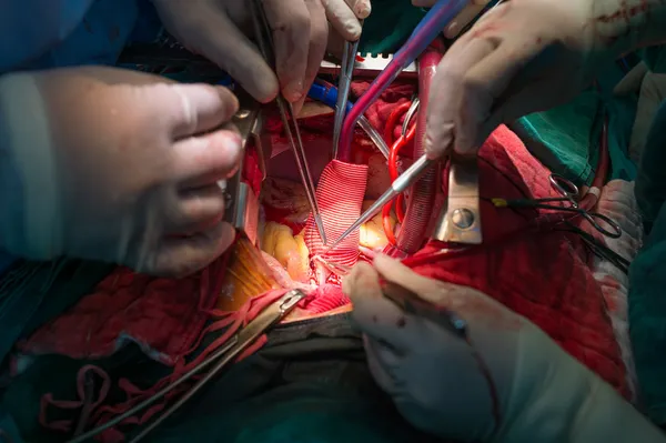 Coronary re implantation in ascending aortic aneurysm — Stock Photo, Image