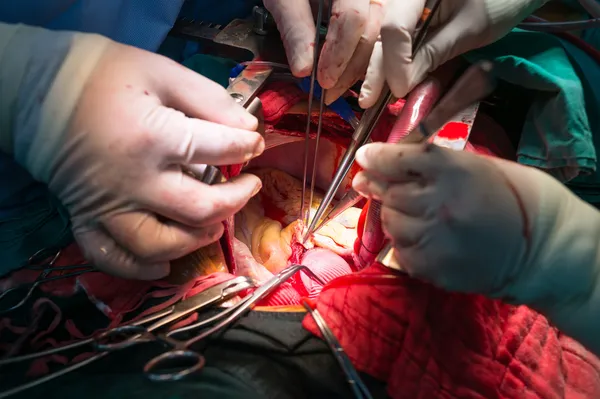 Coronary re implantation in ascending aortic aneurysm — Stock Photo, Image