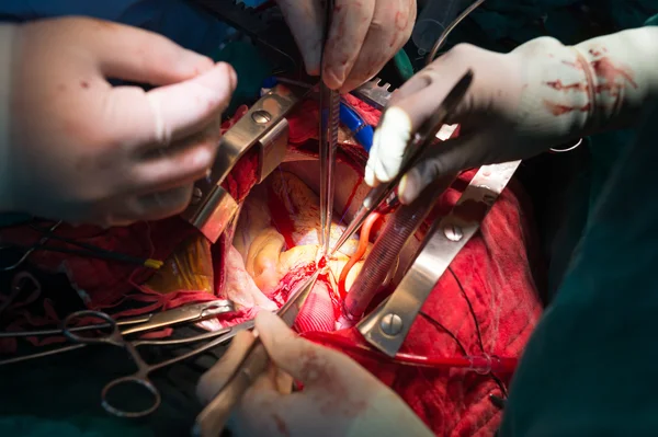 Coronary re implantation in ascending aortic aneurysm — Stock Photo, Image