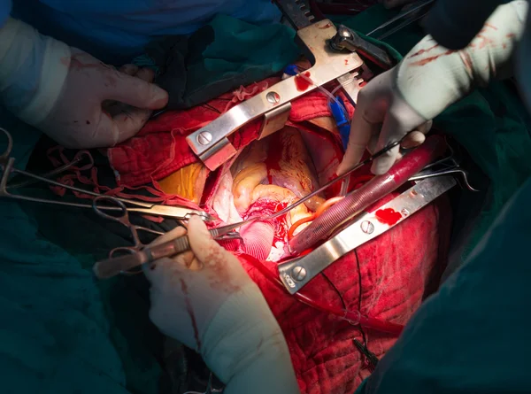 Coronary re implantation in ascending aortic aneurysm — Stock Photo, Image