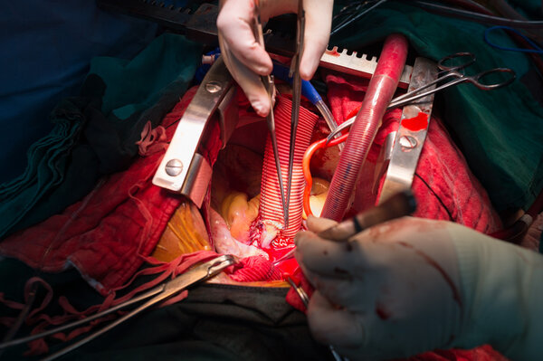 Coronary re implantation in ascending aortic aneurysm