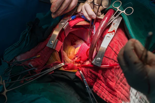 Bentall's operation in ascending aortic aneurysm — Stock Photo, Image