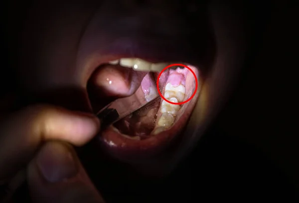 Çocuk Azı Dişlerinin Üzerinde Sakız Kapağı Olan Yaşında Bir Çocuk — Stok fotoğraf