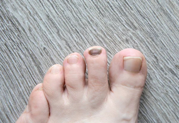 Close View Woman Foot Black Toenail Caused Long Walk Medical — Fotografia de Stock