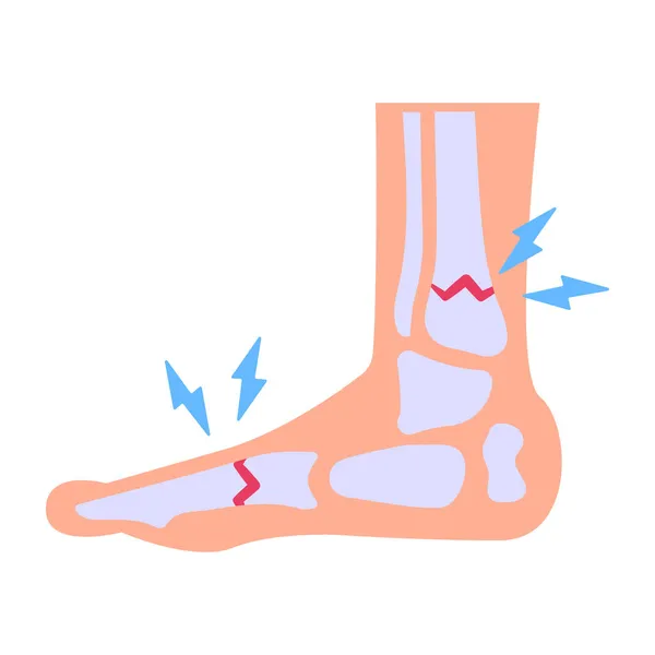 Bacak Tedavisi Ayak Ağrısı Vektör Çizimi — Stok Vektör