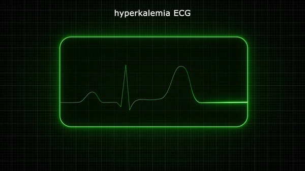 Ecgの3Dイラスト 高カリウム血症 — ストック写真