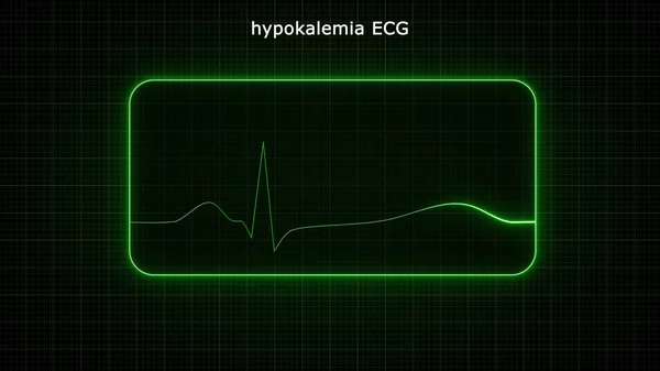 Иллюстрация Экг Гипокалиемия — стоковое фото