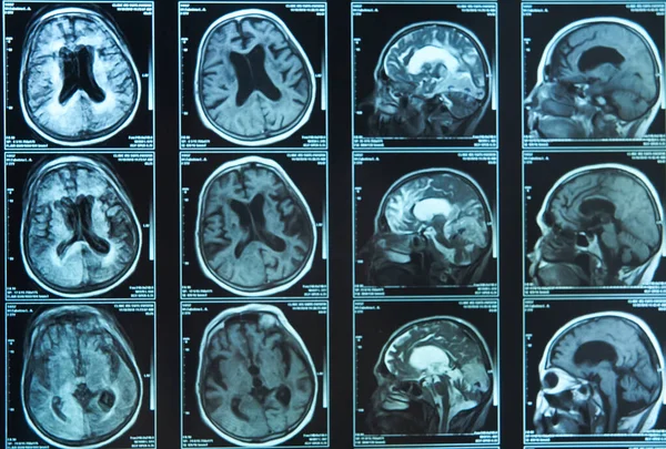 A snapshot of an elderly person's brain scan on magnetic resonance imaging MRI film, for neurological medical diagnosis of brain diseases.