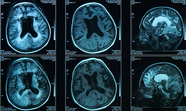 A snapshot of an elderly person's brain scan on magnetic resonance imaging MRI film, for neurological medical diagnosis of brain diseases.
