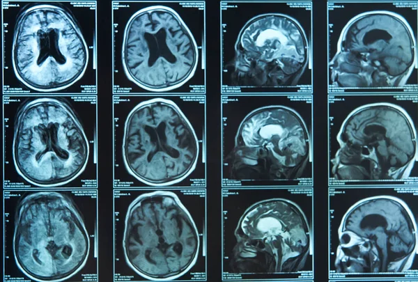 Snapshot Elderly Person Brain Scan Magnetic Resonance Imaging Mri Film Imagem De Stock