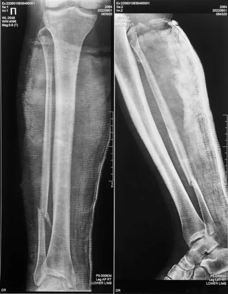 Radiograph of a comminuted fracture of the lower leg with displacement and in two projections, vertical image.
