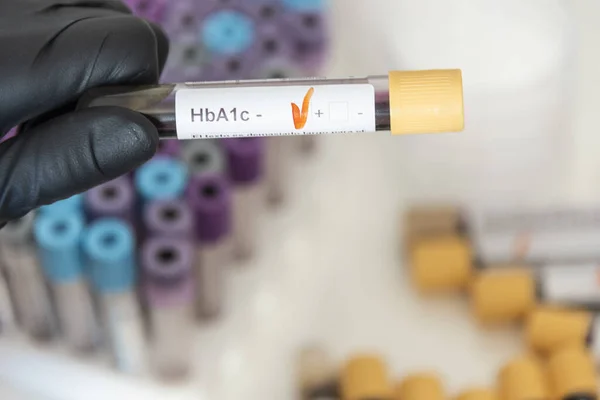 HBA1c diyabetinden pozitif kan örneği yakın çekim.