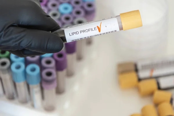 Lipid profilinden pozitif kan örneği yakın çekim.
