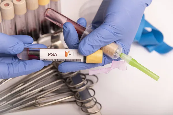 Anormal yüksek PSA testi sonucu olan kan örneği.