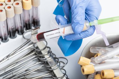 Bilim adamları ellerinde ANTHRAX VIRUS testi için kan örneği olan bir test tüpü tutuyorlar..