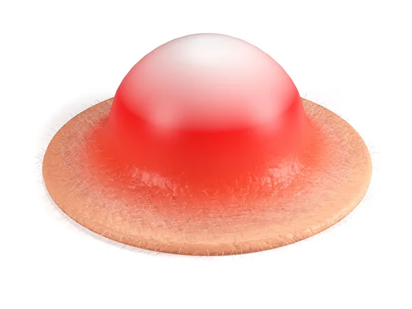 Sivilce illüstrasyon