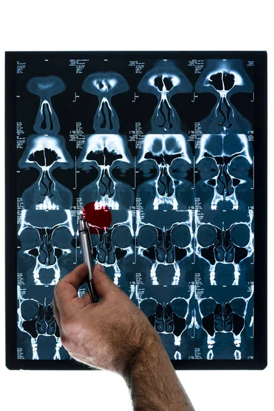 鼻腔内X光鼻窦炎腺样体颅骨X射线人头图像 — 图库照片