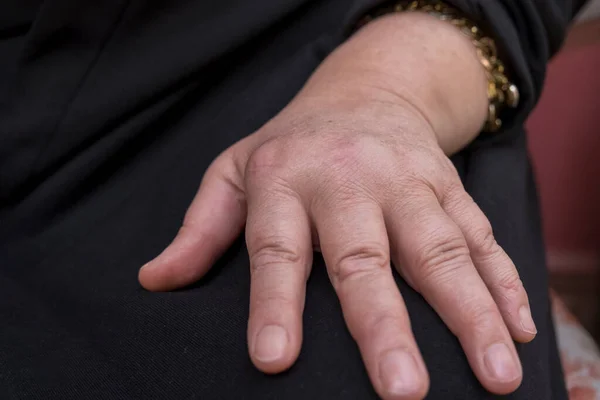 Mão Mulher Deformada Artrite Reumatoide Uma Doença Crônica Progressiva Causando — Fotografia de Stock
