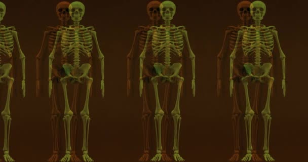 人間の骨格の動きのイラストとノイズやグリッチ効果と古い損傷した画面のオーバーレイ — ストック動画