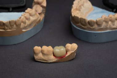 Diş protezi laboratuarı konsepti. 3 boyutlu modelleme için insan dişleri. Çene köprüsü 3D siyah arkaplan üzerindeki bir fotopolimer materyalden yazdırıldı.