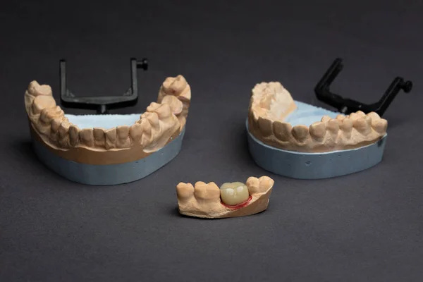Concepto Laboratorio Prótesis Dental Prótesis Dentales Humanas Para Modelado Puente — Foto de Stock