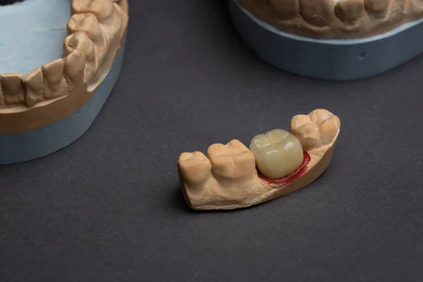 Dental prosthetics laboratory concept. Human teeth dentures for 3d modeling. Jaw dental bridge 3D printed from a photopolymer material on black background.