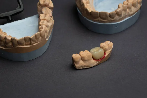 歯科矯正研究室のコンセプト 3Dモデリングのための人間の歯の入れ歯 黒の背景に光高分子材料から印刷された顎歯科ブリッジ3D — ストック写真