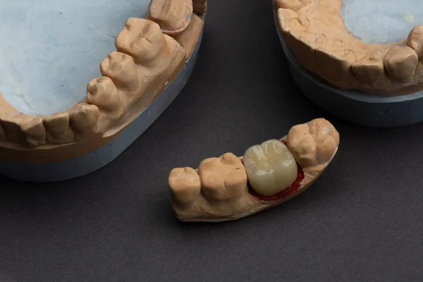 Dental Prosthetics Laboratory Concept Human Teeth Dentures Modeling Jaw Dental — Stock Photo, Image