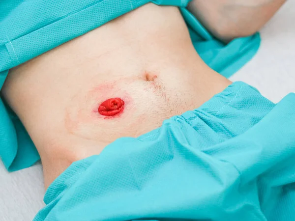 Belly of a young Caucasian male patient in a turquoise disposable medical pajamas with a protruding intestine and scars after surgery with selective focus, close-up side view.Concept of abdominal diseases,colon cancer,colostomy bag.