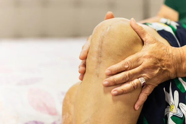 Elderly Woman Show Her Scar Knee Replacement Surgery — Zdjęcie stockowe