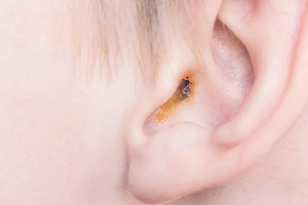 子供の汚れた耳の中の耳のワックスが閉じます。耳の衛生 ストック写真