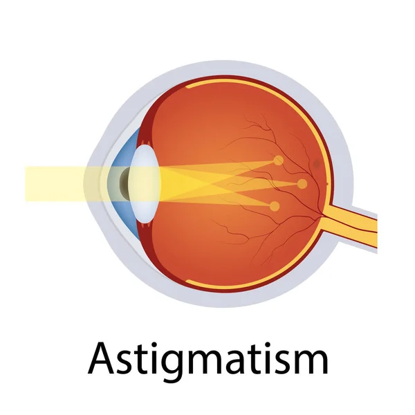 Astigmatismo e disturbi della vista Illustrazione. Concetto di difetto degli occhi. Dettagliato bulbo oculare anatomico con difetto di astigmatismo. Vettore isolato — Vettoriale Stock