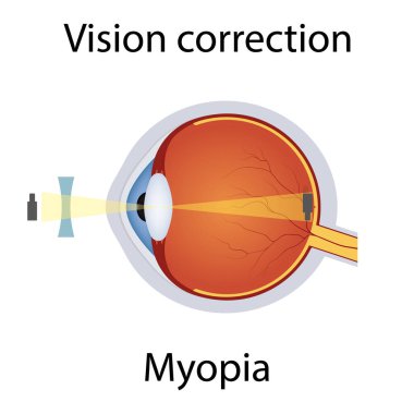 Myopia Illustration 'un vizyon düzeltmesi. Görme bozukluğu. Concave Lens Concept tarafından düzeltilmiş gözler kusuru. Myopia kusurlu Detaylı Anatomi Göz Topu. İzole Vektör