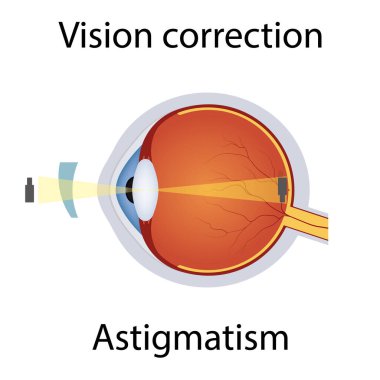 Astigmatizm illüstrasyonunun vizyon düzeltmesi. Görme bozukluğu. Gözler kusuru Lens Kavramı tarafından düzeltildi. Detaylı Astigmatizm Bozukluğu olan Anatomi Göz Topu. İzole Vektör