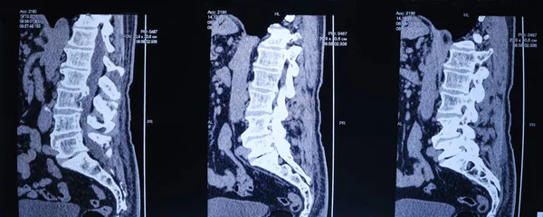 Imagem de RM da coluna vertebral de um paciente com escoliose e protrusão do disco intervertebral. — Fotografia de Stock