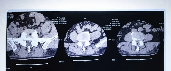 MRT-Aufnahme der Wirbelsäule eines Patienten mit Skoliose und Bandscheibenvorwölbung. — Stockfoto