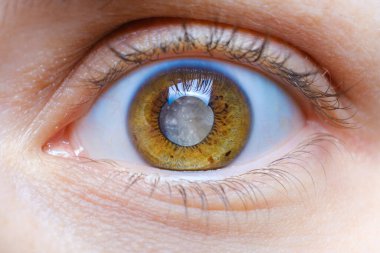 Human eye with clouded lens, white pupil, cataract macro clipart