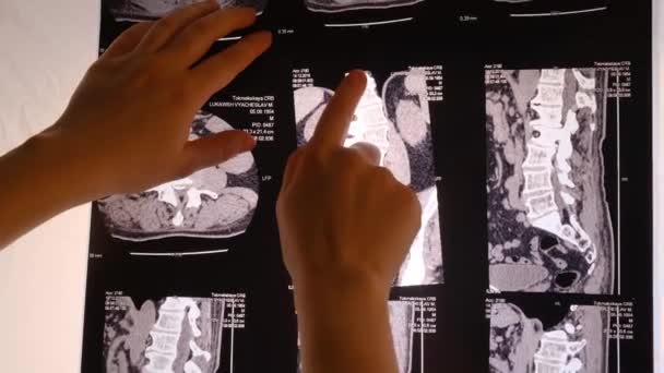 Ο γιατρός δείχνει μια αξονική εικόνα της σπονδυλικής στήλης ενός ασθενούς με σκολίωση και μεσοσπονδύλιο κήλη. — Αρχείο Βίντεο