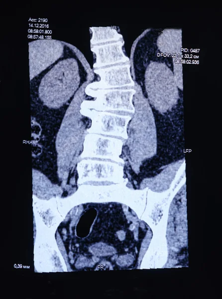 КТ-зображення хребта у пацієнта з сколіозом та випинанням міжхребцевого диска . — стокове фото