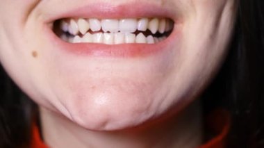 Temporomandibular eklem bozukluğu olan bir hasta maloksiyon, mastikatör kaslarda spazm, çene yanlara doğru yer değiştirme gösterir..