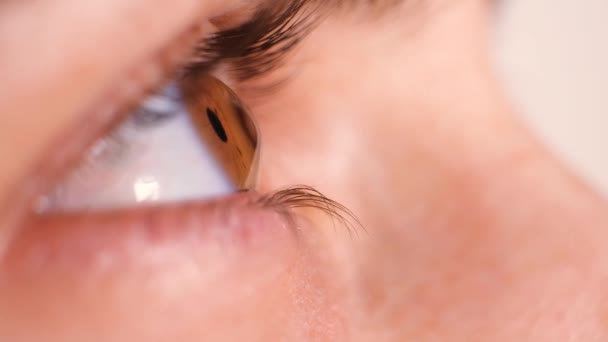 角膜圆锥患者的眼睛，视锥状角膜，严重程度. — 图库视频影像
