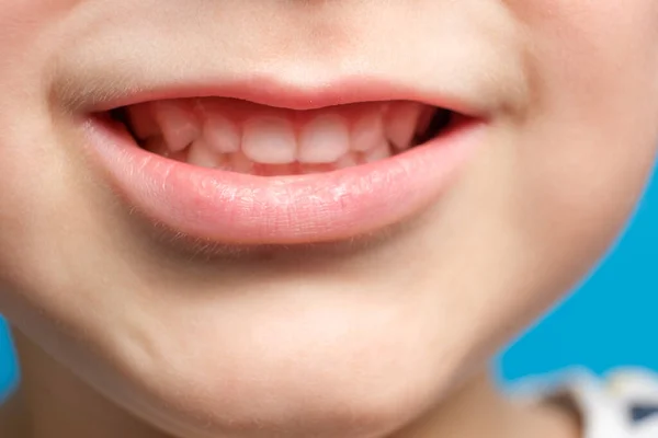 Childrens milk teeth in a child, open mouth, close-up. Pediatric dentistry, thinned enamel — Stock Photo, Image